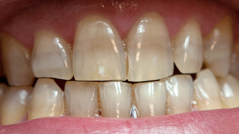Coloração anormal dos dentes