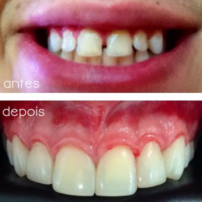 Plástica gengival e aumento dos dentes através de facetas de resina (neste caso) ou porcelana.