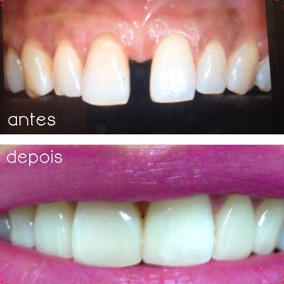 Fechamento de diastema (espaço entre os dentes) com resina
