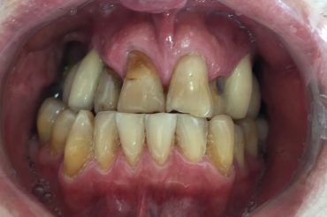 Relatório técnico e guia prático da FDI chamam a atenção para o ônus global da doença periodontal