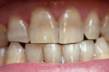 Coloração anormal dos dentes